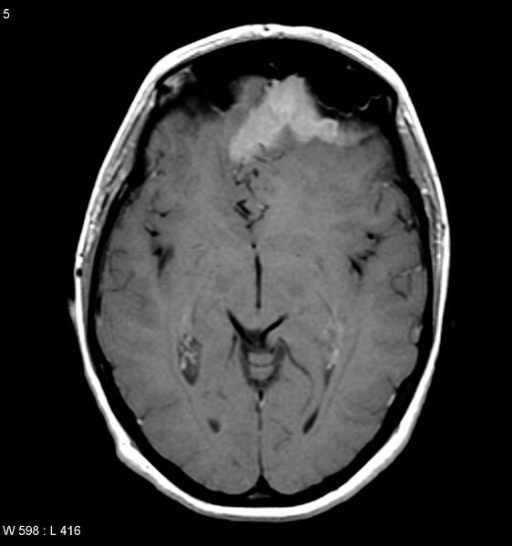 File:Atypical meningioma (WHO grade II) (Radiopaedia 7762-8586 D 1).jpg