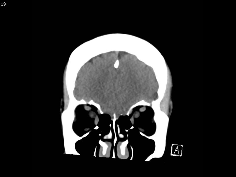File:Atypical meningioma - intraosseous (Radiopaedia 64915-73867 B 18).jpg