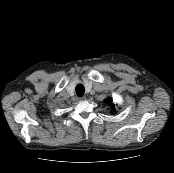 File:Autosomal dominant polycystic kidney disease (Radiopaedia 27851-28094 Axial non-contrast 4).jpg