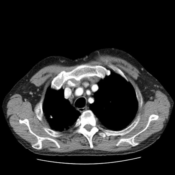 File:Autosomal dominant polycystic kidney disease (Radiopaedia 27851-28094 B 12).jpg