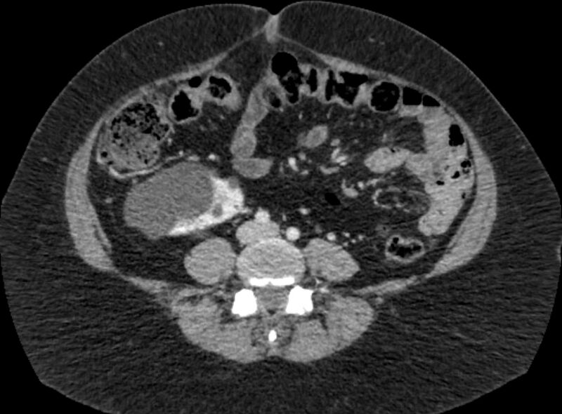 File:Autosomal dominant polycystic kidney disease (Radiopaedia 57124-64017 A 72).jpg