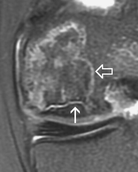 File:Avascular necrosis of the knee (Radiopaedia 2583-42119 STIR 1).jpg