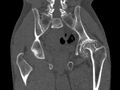Avascular necrosis of the left hip (Radiopaedia 75068-86125 Coronal bone window 54).jpg