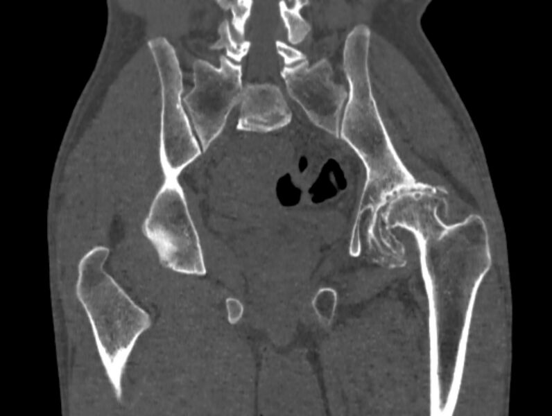 File:Avascular necrosis of the left hip (Radiopaedia 75068-86125 Coronal bone window 54).jpg