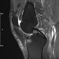 Avulsion fracture of the fibular head (Radiopaedia 74804-85808 Sagittal PD fat sat 16).jpg