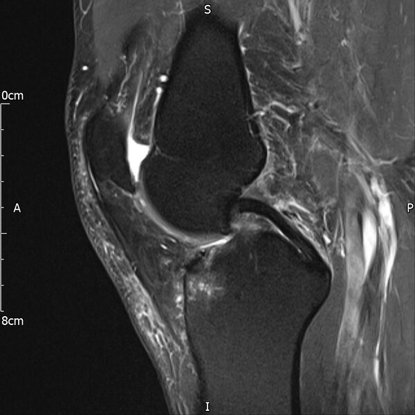 File:Avulsion fracture of the fibular head (Radiopaedia 74804-85808 Sagittal PD fat sat 16).jpg