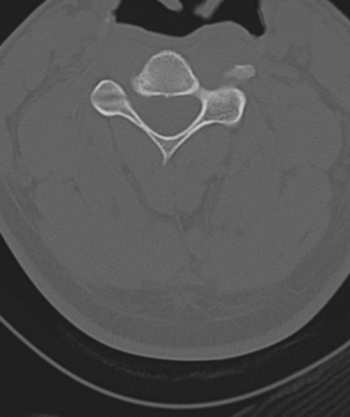 File:Axis peg fracture (type 3) and atlas lateral mass (type 4) fracture (Radiopaedia 37474-39324 Axial bone window 27).png