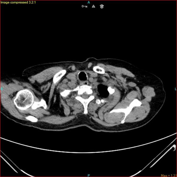 File:Azygos vein aneurysm (Radiopaedia 77824-90130 A 7).jpg