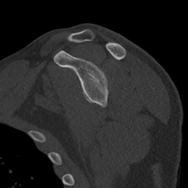 File:Bankart lesion (Radiopaedia 22771-22798 Sagittal bone window 31).jpg