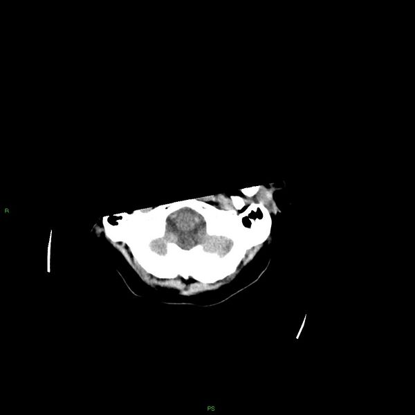 File:Basal ganglia hemorrhage (Radiopaedia 58349-65472 Axial non-contrast 52).jpg
