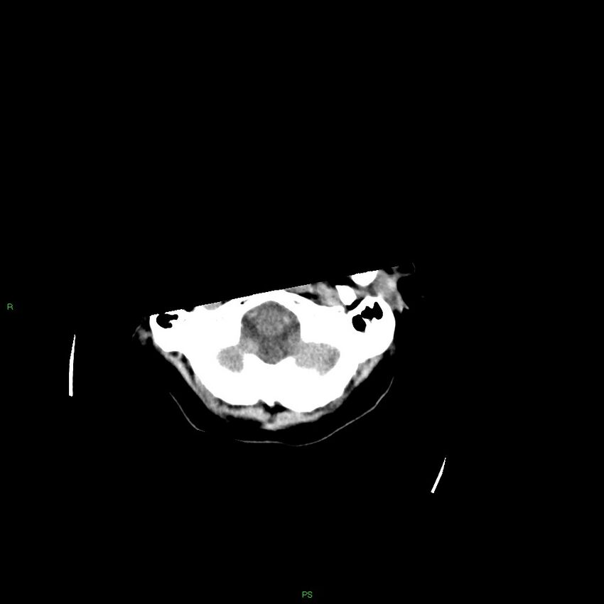 Basal ganglia hemorrhage (Radiopaedia 58349-65472 Axial non-contrast 52).jpg