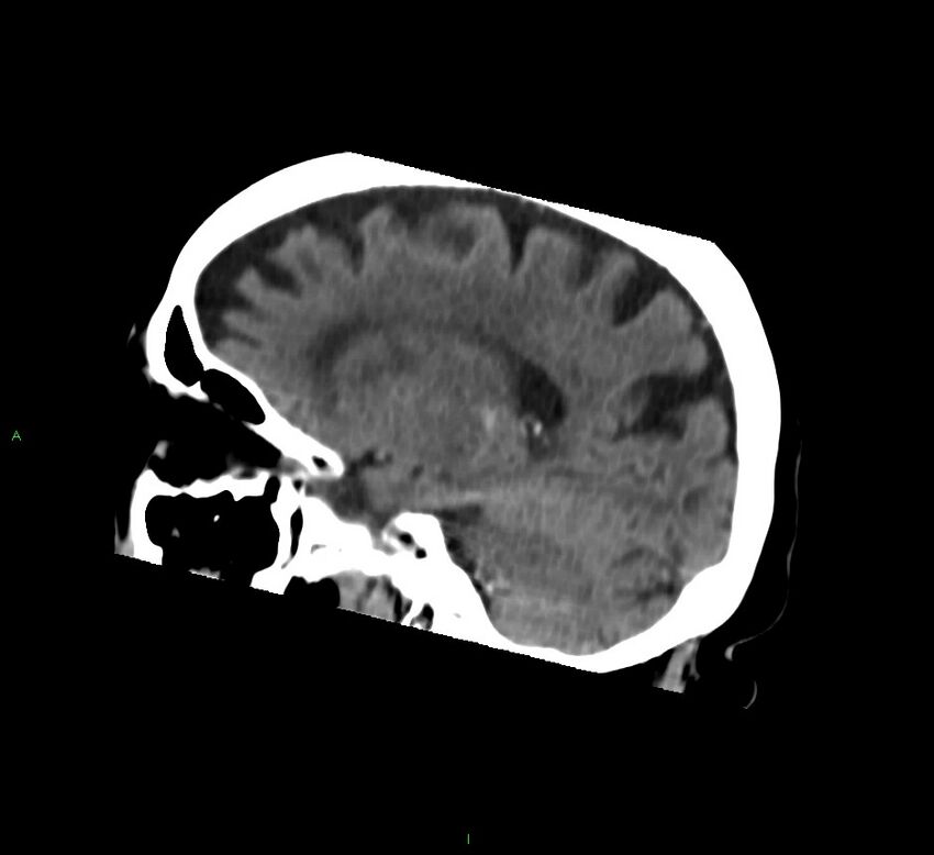 Basal ganglia hemorrhage (Radiopaedia 58762-65984 B 21).jpg