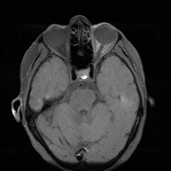 File:Base of skull chondrosarcoma (Radiopaedia 30410-31070 Axial T1 fat sat 12).jpg