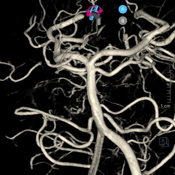 File:Basilar artery perforator aneurysm (Radiopaedia 82455-97734 3D view left VA 38).jpg
