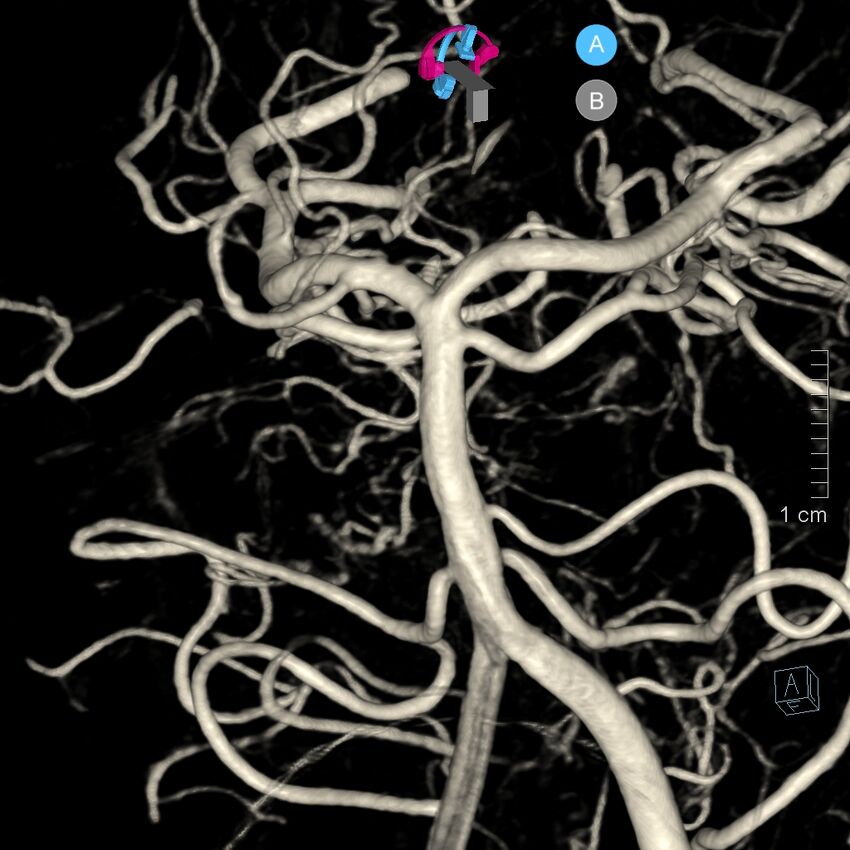 Basilar artery perforator aneurysm (Radiopaedia 82455-97734 3D view left VA 38).jpg