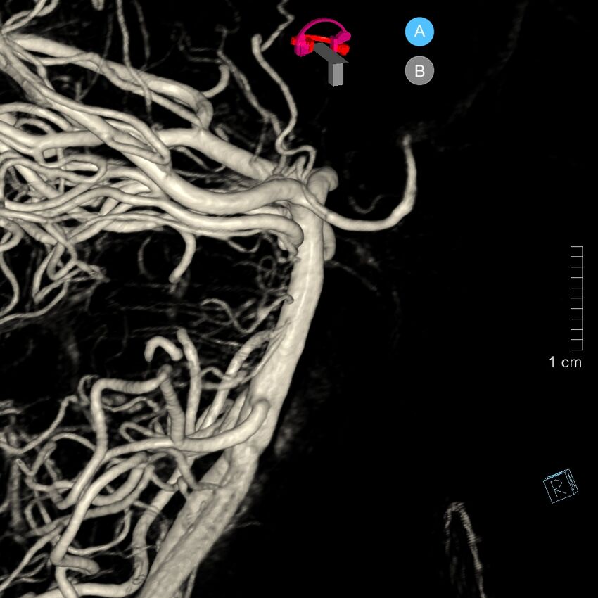 Basilar artery perforator aneurysm (Radiopaedia 82455-97734 3D view left VA 62).jpg