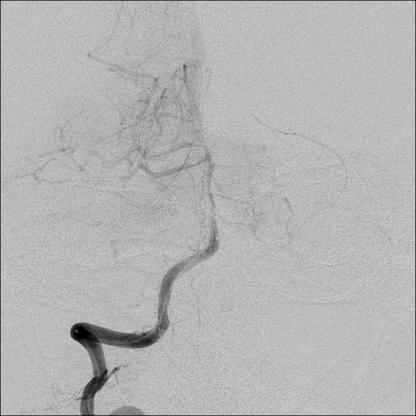 File:Basilar artery thrombosis treated with intra-arterial urokinase (Radiopaedia 34571-35949 B 18).png