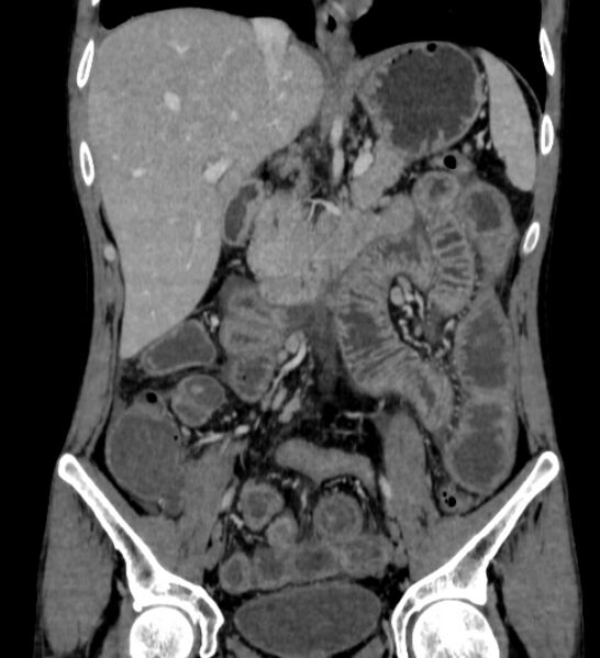 File:Behçet's disease- abdominal vasculitis (Radiopaedia 55955-62570 B 26).jpg