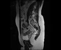 Bicornuate bicollis uterus (Radiopaedia 61626-69616 Sagittal T2 13).jpg