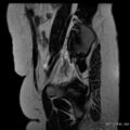 Bicornuate uterus- on MRI (Radiopaedia 49206-54297 Sagittal T2 24).jpg
