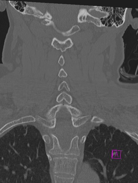 File:Bilateral atlanto-occipital assimilation (Radiopaedia 28350-28603 Coronal bone window 29).jpg