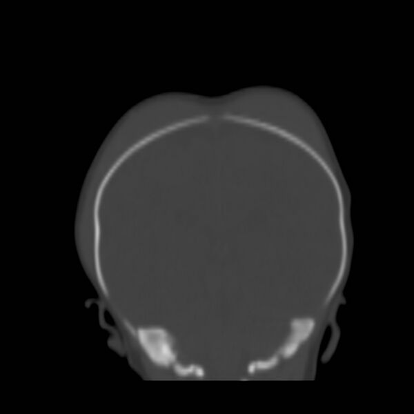 File:Bilateral cephalohematomas and subdural hematomas (Radiopaedia 26778-26929 Coronal bone window 19).jpg