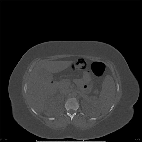 File:Bilateral lumbar ribs (Radiopaedia 25862-26010 bone window 9).jpg