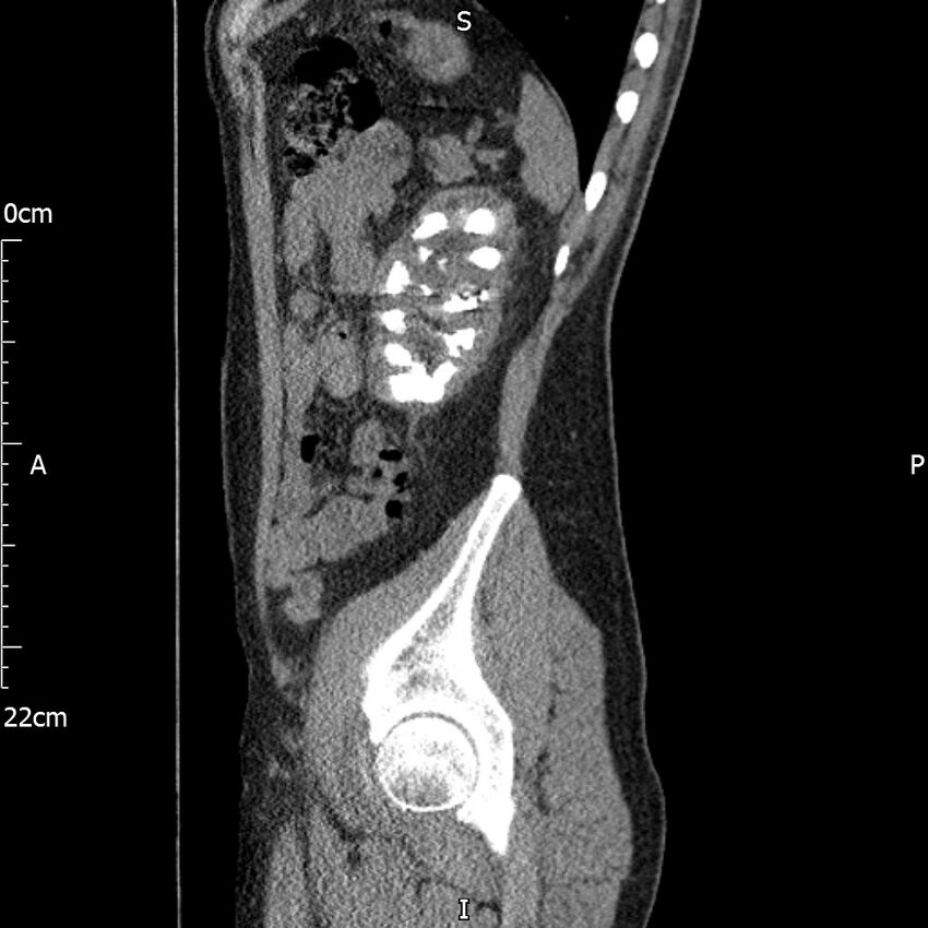 Bilateral medullary nephrocalcinosis with ureteric calculi (Radiopaedia 71269-81569 C 32).jpg