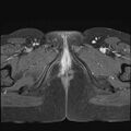 Bilateral ovarian endometriomas (Radiopaedia 87085-103347 Axial T1 C+ fat sat 24).jpg