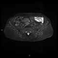 Bilateral ovarian fibroma (Radiopaedia 44568-48293 Axial STIR 4).jpg