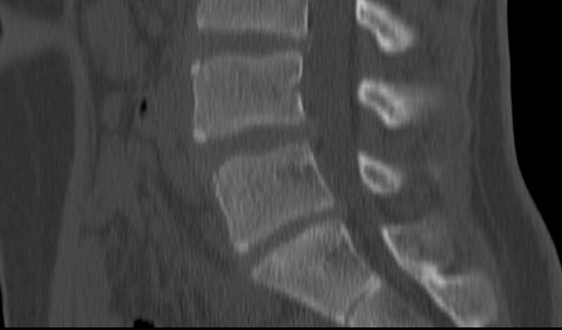 File:Bilateral pars defect (Radiopaedia 26691-26846 Sagittal bone window 30).jpg