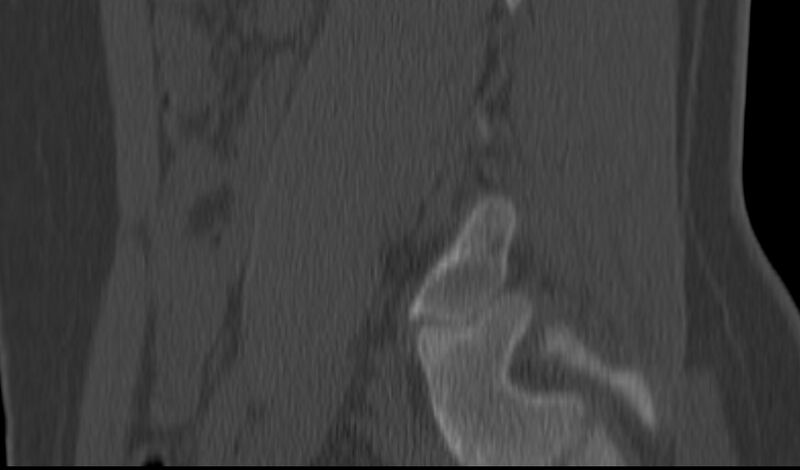 File:Bilateral pars defect (Radiopaedia 26691-26846 Sagittal bone window 50).jpg