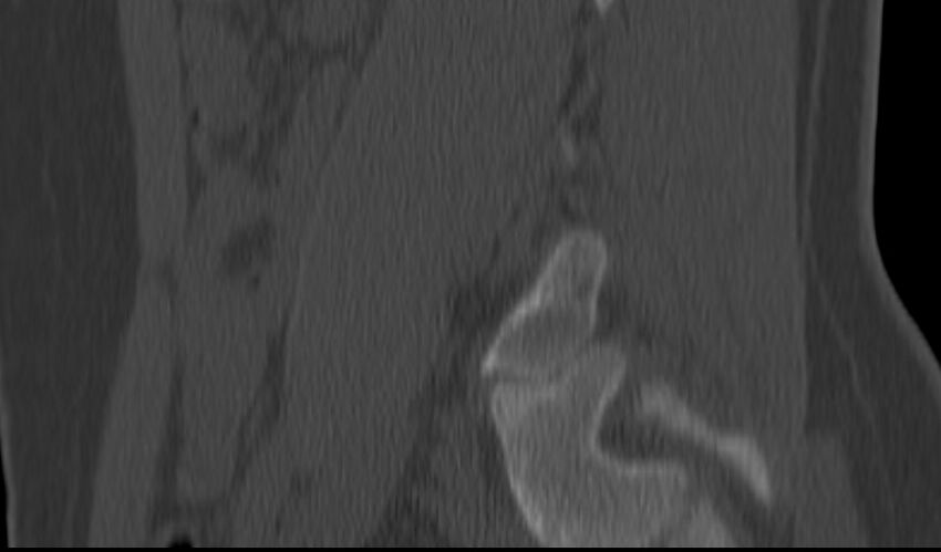 Bilateral pars defect (Radiopaedia 26691-26846 Sagittal bone window 50).jpg