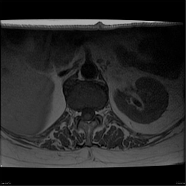 File:Bilateral psoas hematomas (Radiopaedia 24057-24280 T1 38).jpg