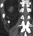 Bile leak from accessory duct(s) of Luschka post cholecystectomy (Radiopaedia 40736-43389 B 64).jpg