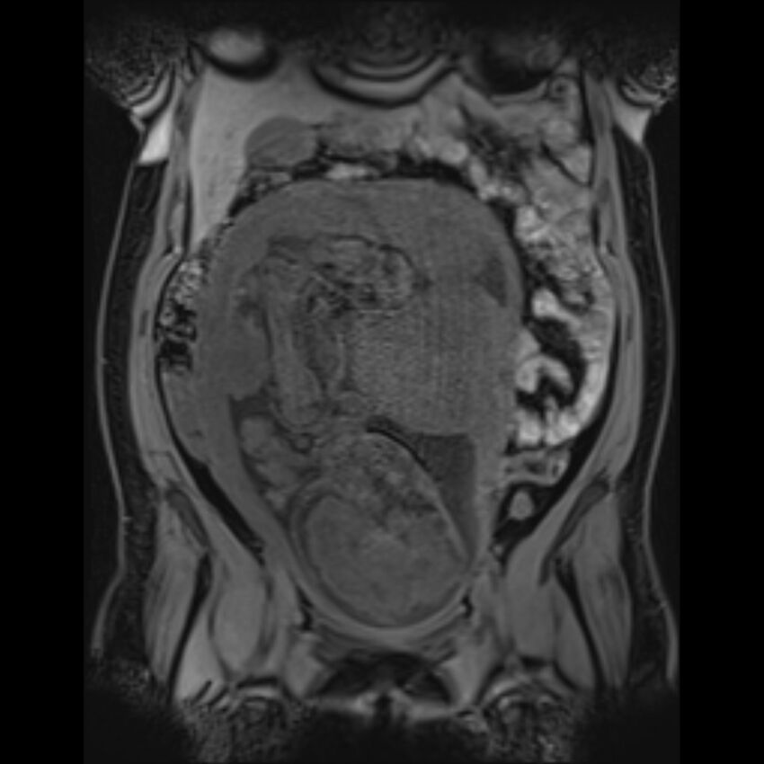 Bilobed placenta accreta (Radiopaedia 69648-79591 Coronal T1 vibe 74).jpg