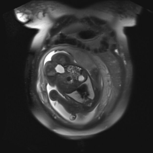 File:Bilobed placenta accreta (Radiopaedia 69648-79591 Coronal T2 fat sat 11).jpg