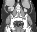 Bladder papillary urothelial carcinoma (Radiopaedia 48119-52951 C 46).png
