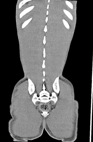 File:Blunt injury to the small bowel (Radiopaedia 74953-85987 B 86).jpg