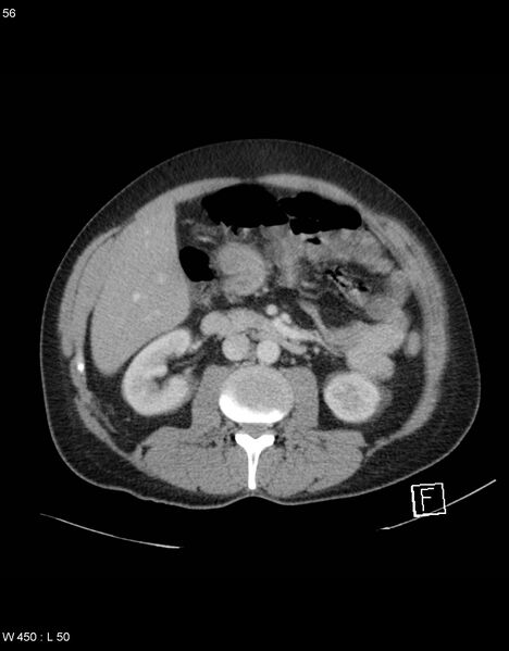 File:Boerhaave syndrome with tension pneumothorax (Radiopaedia 56794-63603 A 28).jpg