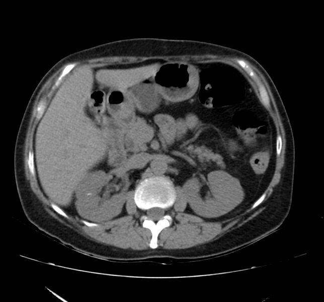 File:Bosniak renal cyst - type IV (Radiopaedia 22929-22953 Axial non-contrast 18).jpg