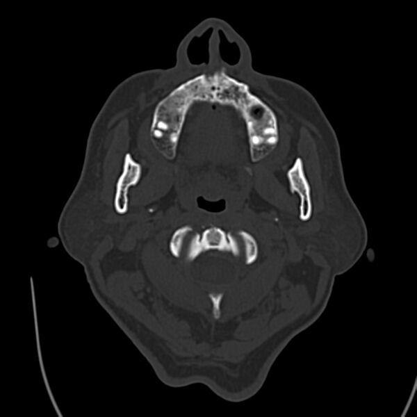 File:Brain Pantopaque remnants (Radiopaedia 78403-91048 Axial bone window 5).jpg