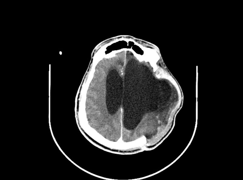File:Brain injury by firearm projectile (Radiopaedia 82068-96088 B 152).jpg