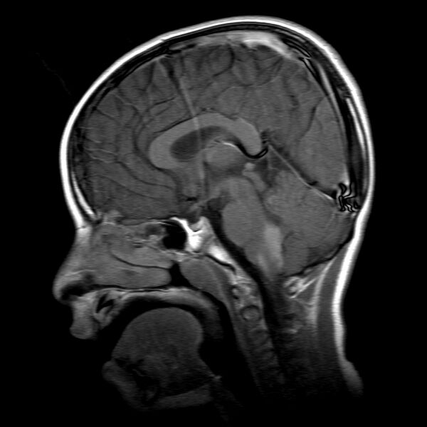 File:Brainstem ganglioglioma (Radiopaedia 10763-11224 Sagittal T1 C+ 10).jpg