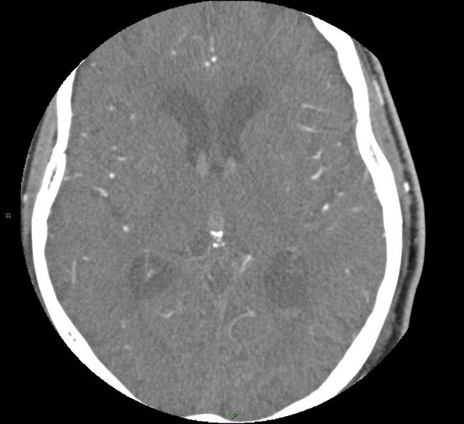 File:Brainstem hemorrhage (Radiopaedia 58794-66028 D 100).jpg