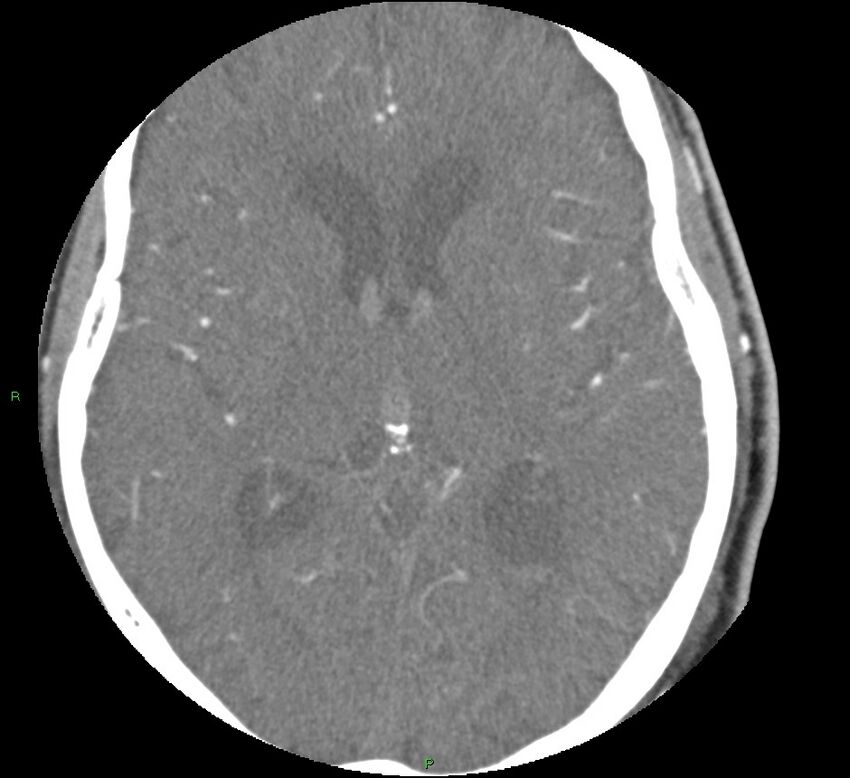 Brainstem hemorrhage (Radiopaedia 58794-66028 D 100).jpg