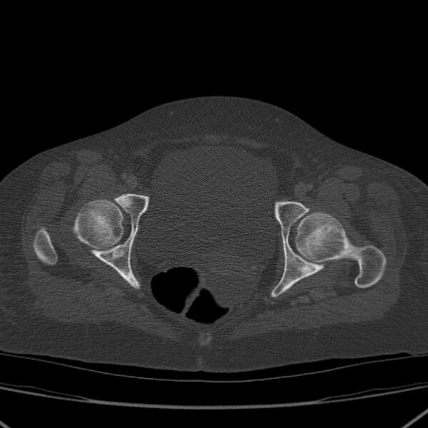 File:Breast cancer metastases - hepatic and skeletal (Radiopaedia 34201-35461 Axial bone window 103).jpg