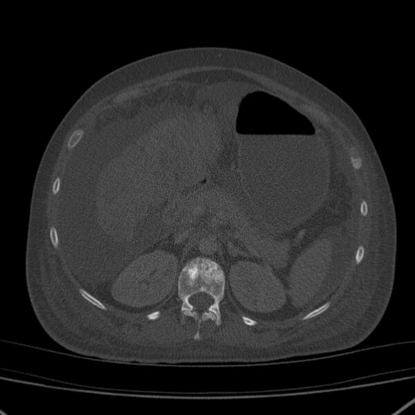 File:Breast cancer metastases - hepatic and skeletal (Radiopaedia 34201-35461 Axial bone window 47).jpg