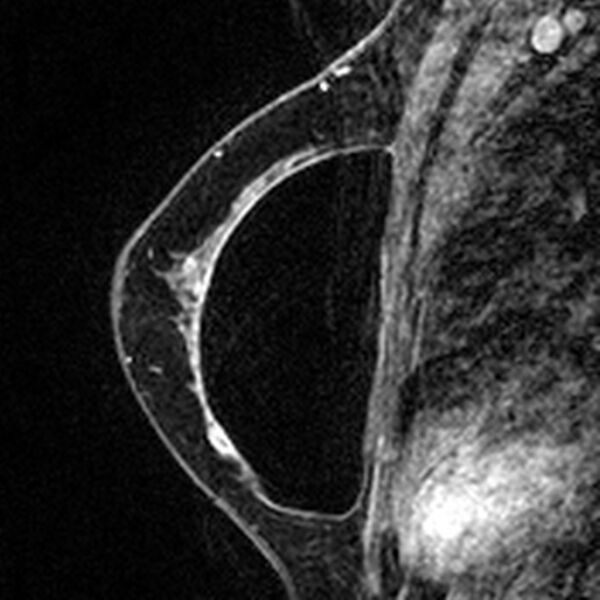 File:Breast implants - MRI (Radiopaedia 26864-27035 Sagittal T2 32).jpg