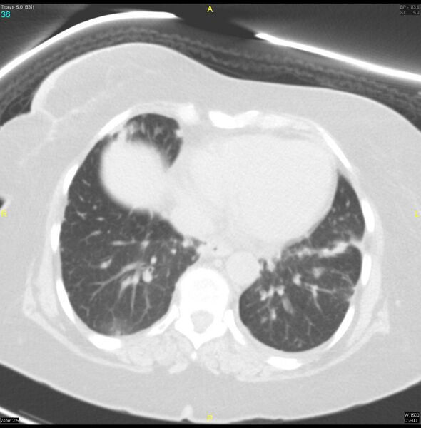 File:Breast primary with lung and bone metastases (Radiopaedia 40620-43228 Axial lung window 36).jpg